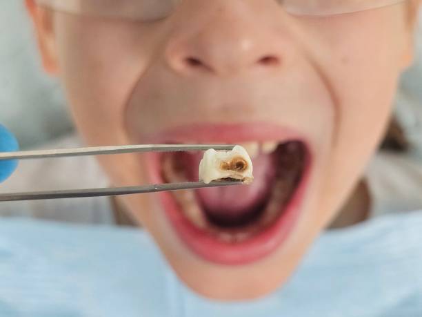 Best Emergency Treatment for Dental Infections or Abscesses in Eureka, KS